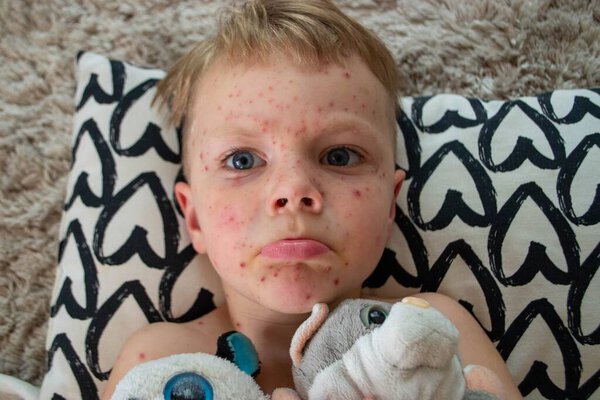 Natural vaccination. Contagious disease. Sick child with chickenpox. Varicella virus or Chickenpox bubble rash on child body and face. High quality photo