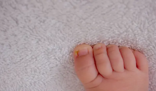 Baby Pus Nail Grew Finger Selective Focus — Stock Photo, Image