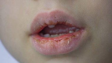 boy with chapped lips treatment. Selective focus. clipart