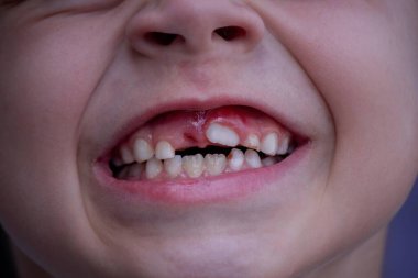 Sağlıksız bebek dişlerine yakın çekim. Çocuktaki hastalıklı dişler. Hasta dişli bir çocuğun portresi..