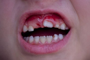 Bir çocuk süt dişini kaybetti. Çocuk. Bebek dişi kavramı..