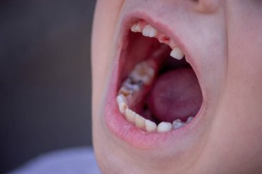 Sağlıksız bebek dişlerine yakın çekim. Çocuktaki hastalıklı dişler. Hasta dişli bir çocuğun portresi..