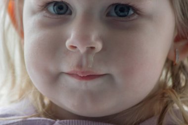 Küçük bir çocuğun yüzüne ve burnuna sümükle yakın çekim. Çocuklarda soğuk, akan burun, alerji.