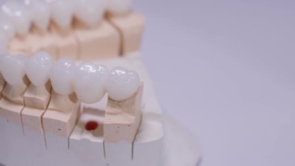 Штучна Щелепа Зубними Коронками Обертаються Білому Тлі Стоматологічний Протез Штучний — стокове відео