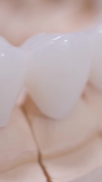 Вертикальне Відео Цирконієві Коронки Керамічні Зуби Імплантатом Гіпсовій Моделі Ізольовані — стокове відео