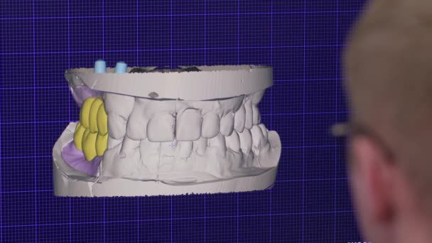Програма Комп Ютерному Дисплеї Використовується Стоматологом Реставрації Зубів Програма Проектування — стокове відео