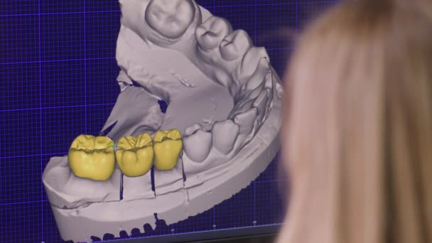 義歯のための女性歯科技術者が使用するコンピュータディスプレイのプログラム 治療のための義歯の設計のためのプログラム — ストック動画