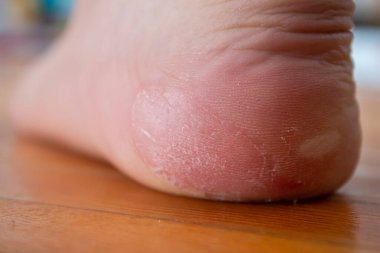 Ayağında deri kabarcıkları var. Cilt sorunları.