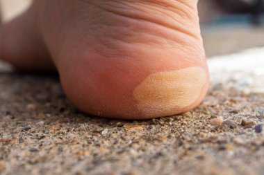 Ayağında deri kabarcıkları var. Cilt sorunları.