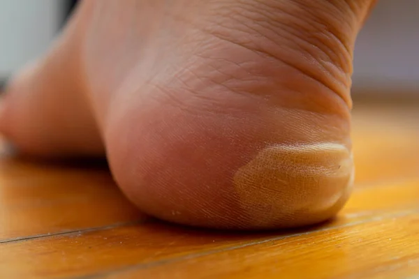 Blister on the foot. Foot injury concept. Health problems.