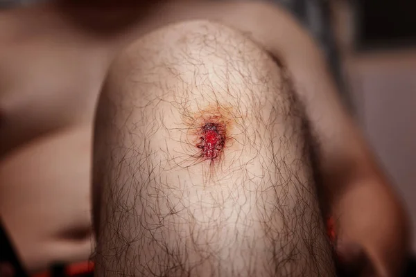 Closeup Fresh Wound Man Knee Accident — Stock Photo, Image