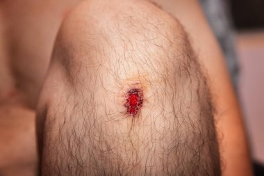 Kazadan dolayı dizinde taze bir yara izi var..