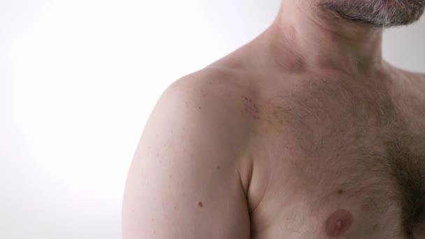 医疗护理 创伤专家外科技术 病人肩关节脱位后的皮肤特写恢复 慢动作确定射击 — 图库视频影像