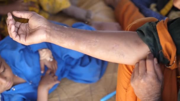在巴基斯坦 一个皮肤剥落或剥落的少女手和一个看着相机的小男孩的视频 — 图库视频影像