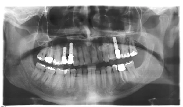 Diş implantlı x-ray resmi