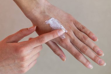 Kuru cilde nemlendirici krem uygulanıyor. Kuru cilde beyaz nemlendirici krem süren bir elin yakın çekimi, nötr bir arkaplana karşı kişisel bakım ve cilt rutinlerini vurguluyor