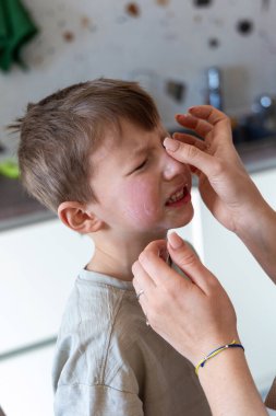 Anne, çocukların sinirli yüzüne krem sürüyor. Bir annenin, genç oğullarına nazikçe yatıştırıcı krem sürerken ki görüntüsü kırmızı ve rahatsız edici yanak.