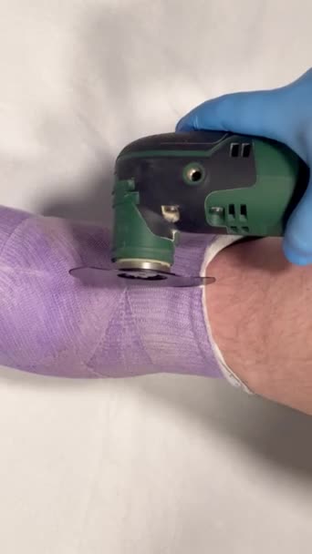 去除石膏的医疗程序 正在使用的专业医疗设备 从腿上取出铸件的垂直视频 — 图库视频影像