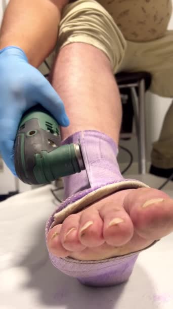 粉砕機によるプラスターの極端な除去 男は電気ソーで鋳造された石膏を切った バーティカルビデオ 青い手袋切断整形外科包帯の男性の手 — ストック動画