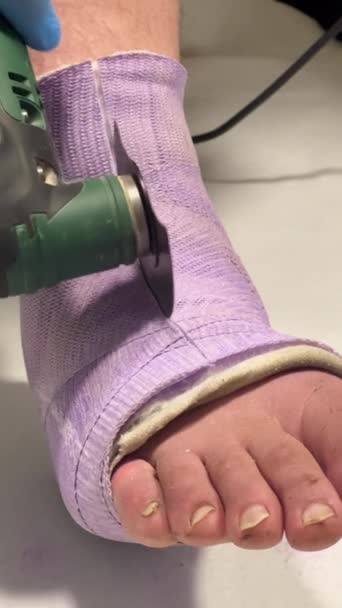 Человек Повредил Ногу Нога Гипсе Мужчина Ждет Операции Удалению Гипса — стоковое видео