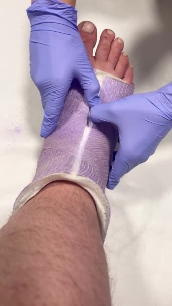 护士从一个人的腿上取出一个矫形器 一名医士手戴着蓝色手套 一名男性病人腿上缠着紫色绷带的特写 — 图库视频影像