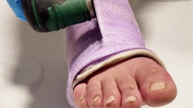 Beyaz arka planlı klinik bir ortamda, elektrikli testereyle bacağındaki alçıyı çıkarma sürecinin videosu. Kavram: İyileşme ve iyileşmenin son adımları.