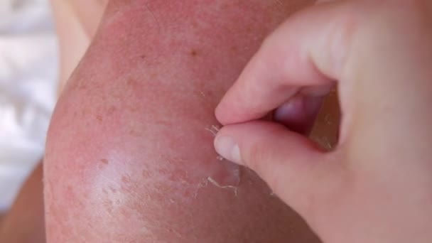 Sunburn Closeup Peeling Sunburned Skin Back Shoulder Skin Peels Strong — стоковое видео