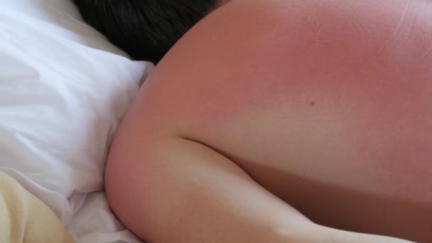 肌に日焼け ホテルのベッドに横になっている男の背中と肩の赤い日焼けした皮膚 — ストック動画