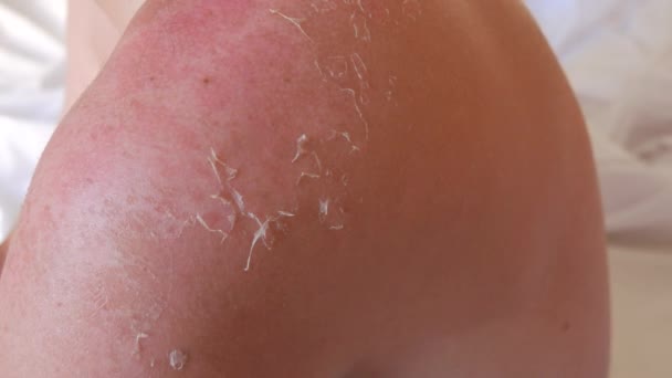 Sunburn Closeup Peeling Sunburned Skin Back Shoulder Skin Peels Strong — Vídeo de Stock