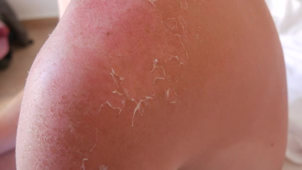 Sonnenbrand Nahaufnahme Von Peeling Sonnengebrannter Haut Auf Rücken Und Schulter — Stockvideo