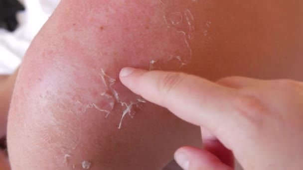 Sunburn Closeup Peeling Sunburned Skin Back Shoulder Skin Peels Strong — ストック動画