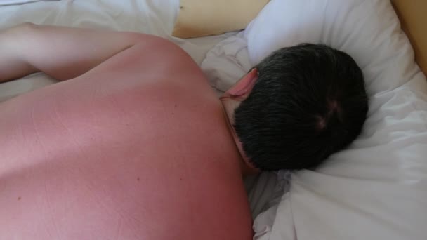 肌に日焼け ホテルのベッドに横になっている男の背中と肩の赤い日焼けした皮膚 — ストック動画
