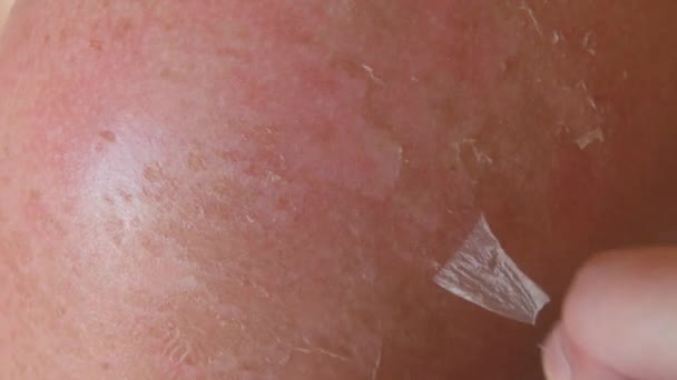 Sunburn Closeup Peeling Sunburned Skin Back Shoulder Skin Peels Strong — Stockvideo