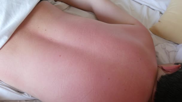 Quemaduras Solares Piel Piel Roja Quemada Por Sol Espalda Los — Vídeo de stock