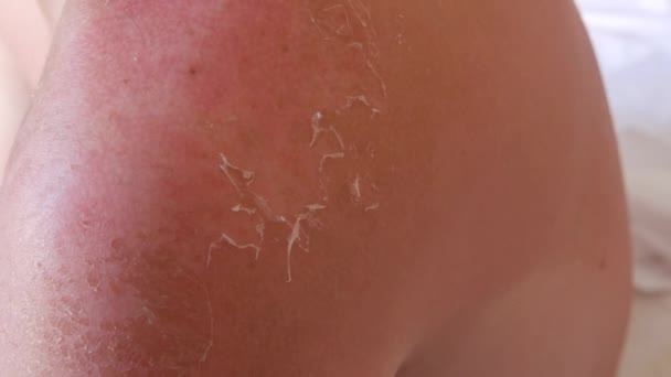 Sonnenbrand Nahaufnahme Von Peeling Sonnengebrannter Haut Auf Rücken Und Schulter — Stockvideo