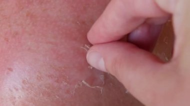 Güneş yanığı: Sırtında ve omzunda güneş yanığı var. Güneş gördükten sonra derisi soyulur. El güneş yanığından yanmış deriyi soymaya yardım eder.