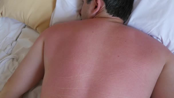 Κάψιμο Από Τον Ήλιο Στο Δέρμα Κόκκινο Ηλιοκαμένο Δέρμα Της — Αρχείο Βίντεο