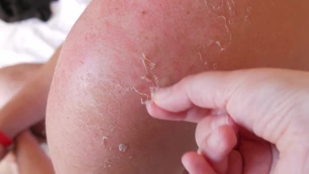 Sunburn Closeup Peeling Sunburned Skin Back Shoulder Skin Peels Strong — Stok Video