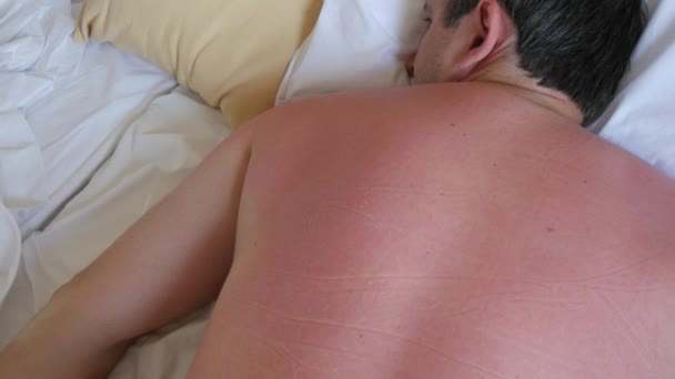 Oparzenia Słoneczne Skórze Czerwona Opalona Skóra Pleców Ramion Mężczyzny Który — Wideo stockowe