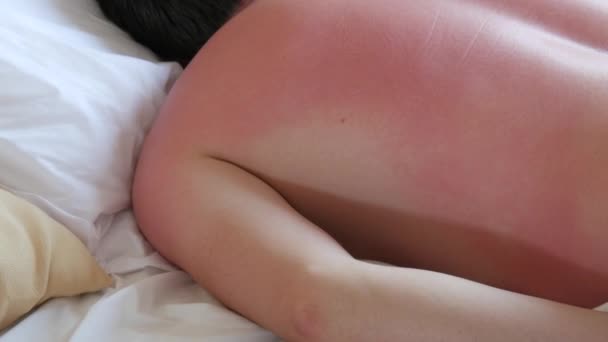 Sunburn Skin Red Sunburned Skin Back Shoulders Man Who Lies — Stock Video