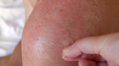 Güneş yanığı: Sırtında ve omzunda güneş yanığı var. Güneş gördükten sonra derisi soyulur. El güneş yanığından yanmış deriyi soymaya yardım eder.