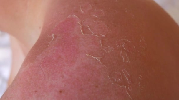 Sunburn Closeup Peeling Sunburned Skin Back Shoulder Skin Peels Strong — Stock video