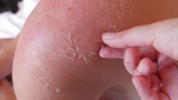 Sunburn Closeup Peeling Sunburned Skin Back Shoulder Skin Peels Strong — Vídeos de Stock