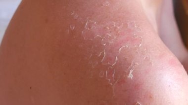 Sunburn: Closeup of Peeling sunburned skin on back and shoulder. Skin peels off after the strong sun. The hand helps to peel off the burnt skin from a sunburn