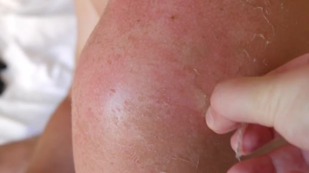 Sunburn Closeup Peeling Sunburned Skin Back Shoulder Skin Peels Strong — Stockvideo