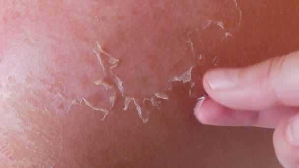 Sunburn Closeup Peeling Sunburned Skin Back Shoulder Skin Peels Strong — 图库视频影像