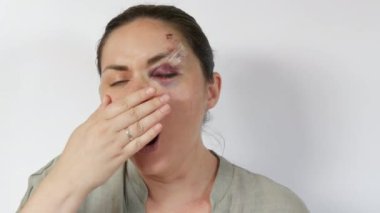 Genç bir kadın kameraya doğru esniyor. Genç bir kadının gözünün altında morluklar, taze morluklar ve darbeden dolayı alnında çizikler var. Aile içi şiddet mağdurunun korkmuş yüzü.