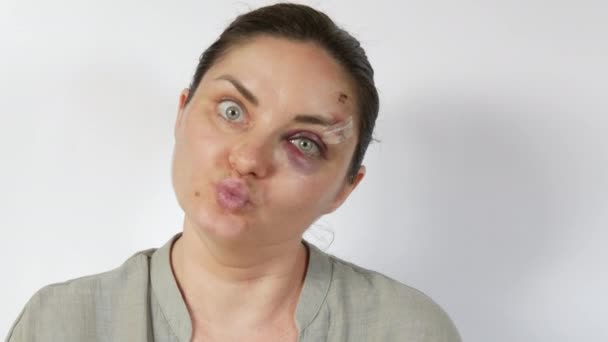Woman Dances Merrily Grimaces Camera Real Bruise Hematoma Eye Young — Stock Video