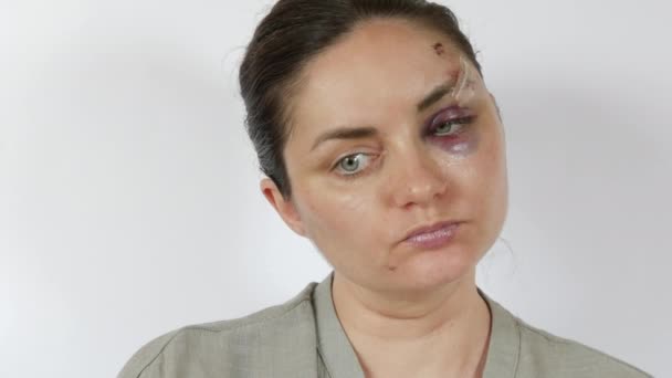 Large Real Bruise Hematoma Eye Young Woman Fresh Purple Bruise — Stock Video