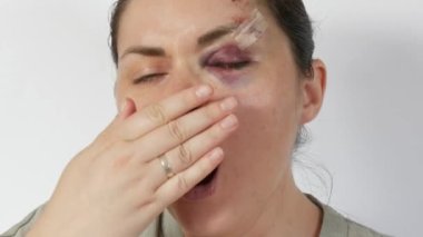 Genç bir kadın kameraya doğru esniyor. Genç bir kadının gözünün altında morluklar, taze morluklar ve darbeden dolayı alnında çizikler var. Aile içi şiddet mağdurunun korkmuş yüzü.